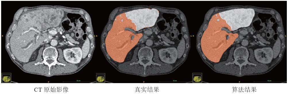 肝脏及结节分割技术